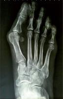 Chirurgie de l'hallux valgus à Annecy