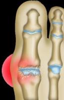 Chirurgie de l'hallux rigidus à Annecy Chirurgie de l'hallux rigidus à Annecy