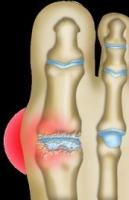 Chirurgie de l'hallux rigidus à Annecy