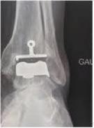 arthrose aux chevilles