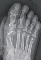 Opération de l'hallux valgus avec durillons plantaires douloureux à Annecy Opération de l'hallux valgus avec durillons plantaires douloureux à Annecy