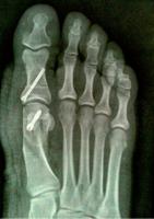 Opération de l'hallux valgus à Annecy, près de Seynod Opération de l'hallux valgus à Annecy, près de Seynod