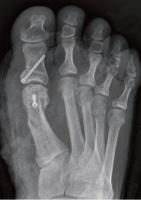 Chirurgie de l'hallux valgus avec durillons plantaires à Annecy