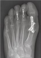 Opération de l'hallux valgus à Annecy, près de Sévrier Opération de l'hallux valgus à Annecy, près de Sévrier