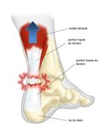 Opération suite à la rupture du tendon d'Achille à Annecy