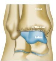 arthrose cheville