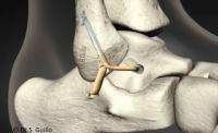 Dr Boniface : Ligamentoplastie de cheville sous arthroscopie: Soirée de formation le 1er Juin 2017