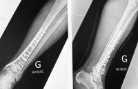 Urgences pied et cheville : chirurgie traumatologique  -> fracture du pilon tibial