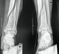 Urgences pied et cheville : chirurgie traumatologique  -> fracture du pilon tibial