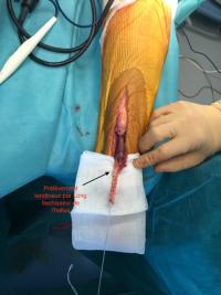 Rupture d'un tendon d'Achille à  3 mois : réparation par transfert tendineux