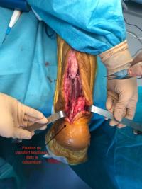 Rupture d'un tendon d'Achille à  3 mois : réparation par transfert tendineux