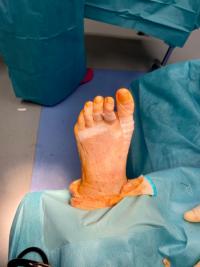 Cas d'une chirurgie d'un avant-pied complexe  : hallux valgus, griffes et métatarsalgies