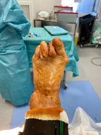 Cas d'une chirurgie d'un avant-pied complexe  : hallux valgus, griffes et métatarsalgies