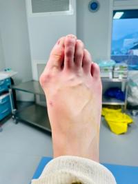 Quelle correction après une chirurgie du pied d'HALLUX VALGUS ?