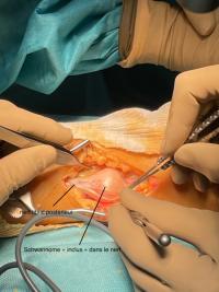 Cas clinique :  Schwannome du nerf tibial postérieur à la cheville