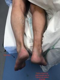 Rupture d'un tendon d'Achille à  3 mois : réparation par transfert tendineux