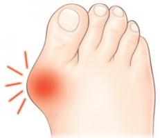 Votre chirurgien orthopédiste, à Annecy, vous explique l'hallux valgus