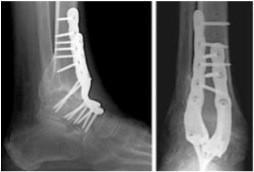 chirurgie arthrose cheville