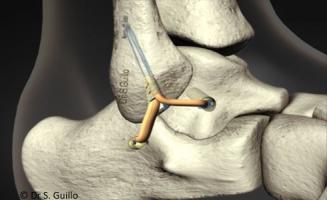 Votre chirurgien orthopédiste à Annecy traite l'instabilité de la cheville