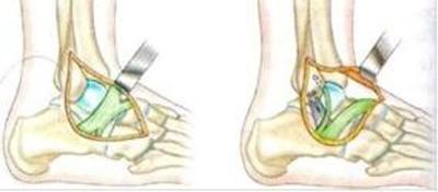 Ligamentoplastie par renforcement au frondiforme Ligamentoplastie par renforcement au frondiforme