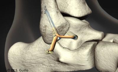 Ligamentoplastie avec reconstruction anatomique des ligaments Ligamentoplastie avec reconstruction anatomique des ligaments