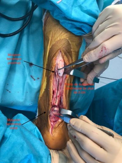Rupture d'un tendon d'Achille à  3 mois : réparation par transfert tendineux