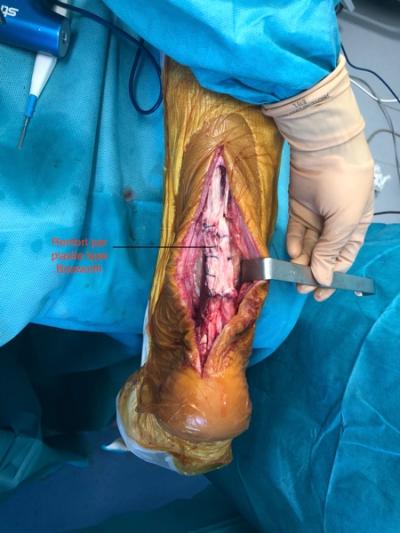Rupture d'un tendon d'Achille à  3 mois : réparation par transfert tendineux