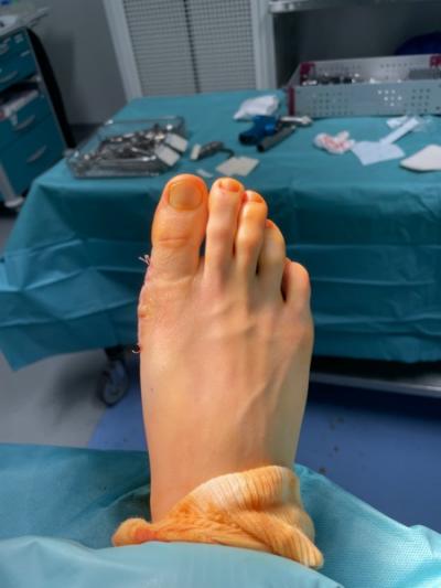 Quelle correction après une chirurgie du pied d'HALLUX VALGUS ?