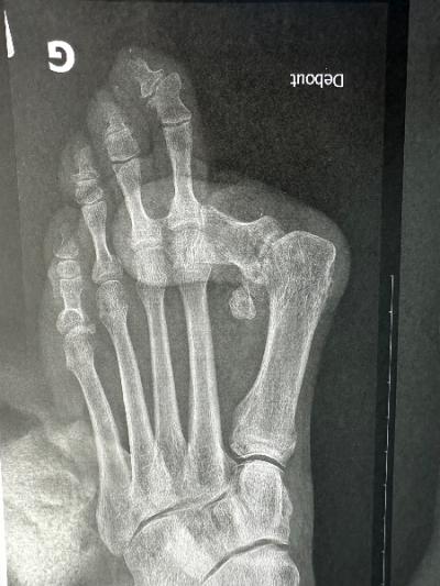 Cas clinique : prise en charge chirurgicale d'un hallux valgus 