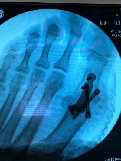 Cas clinique : prise en charge chirurgicale d'un hallux valgus 