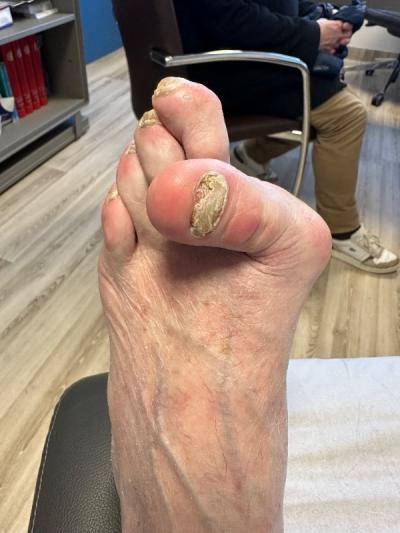 Cas clinique : prise en charge chirurgicale d'un hallux valgus 