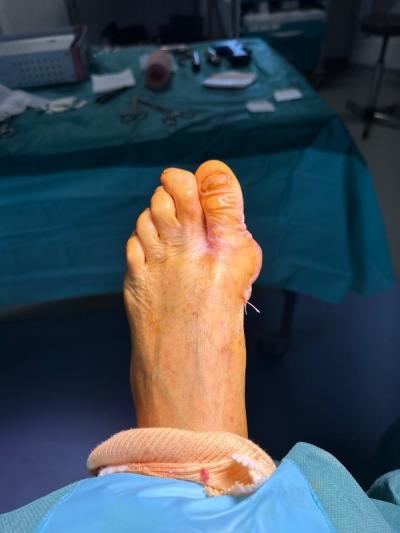 Cas clinique : prise en charge chirurgicale d'un hallux valgus 
