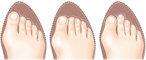 Causes de l'hallux valgus