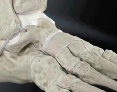 Ligamentoplastie de la cheville sous arthroscopie 